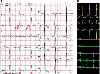Case report: Widely split P' waves in a patient with focal atrial tachycardia